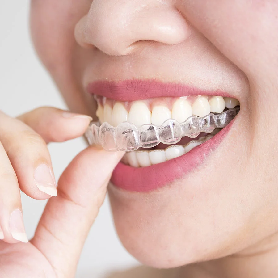 Ortodoncia Invisible en Almoyna Dental