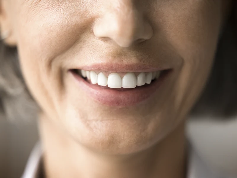 Sonrisa con implantes dentales