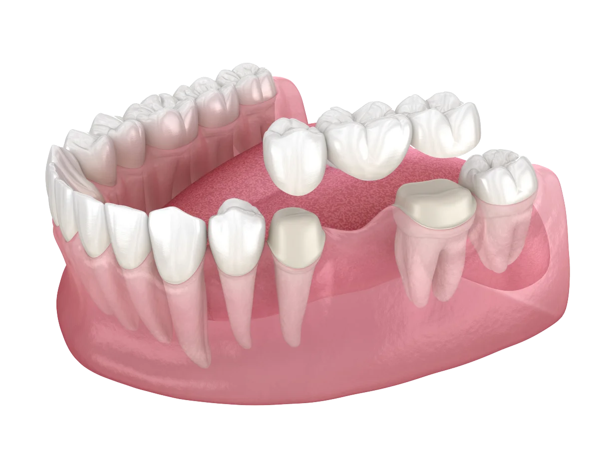 Prótesis dentales