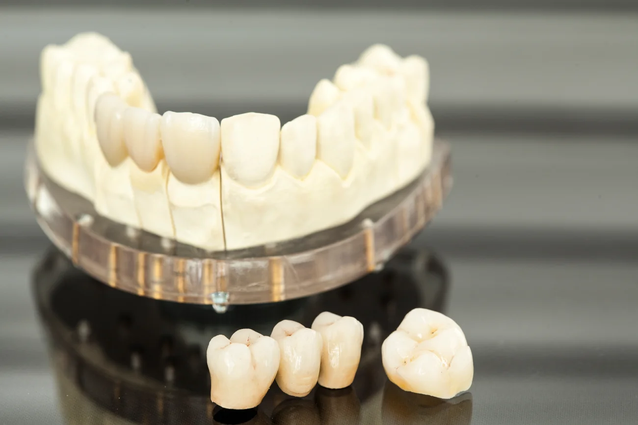 Puentes Dentales Fijos​