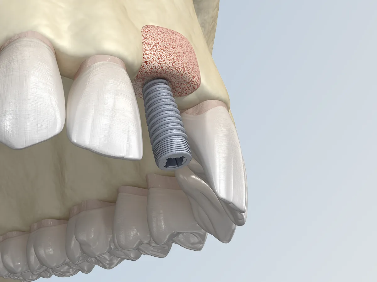 Implantes con elevación atraumática de seno​