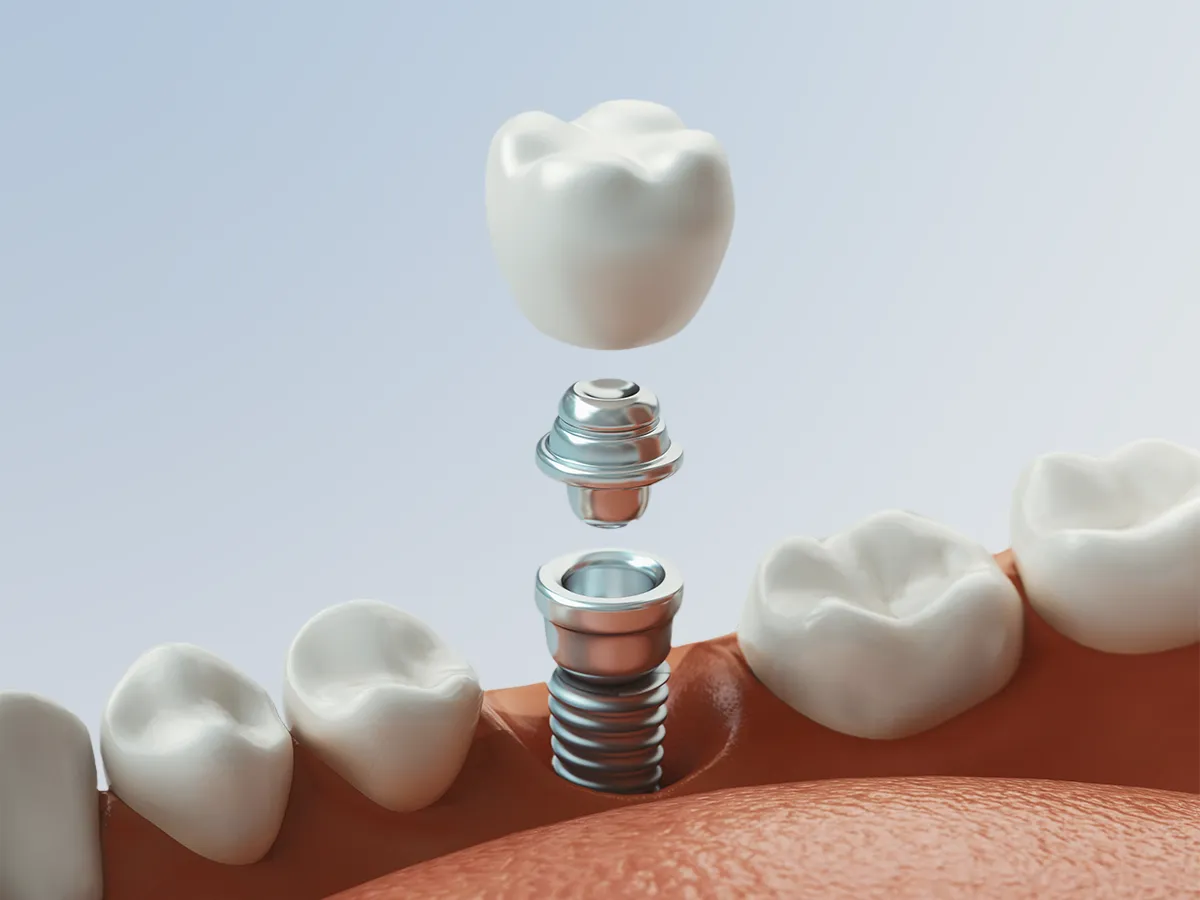 Implantes convencionales