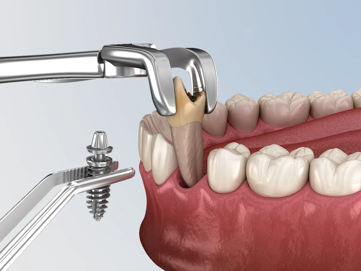 Implantes inmediatos tras extracción​