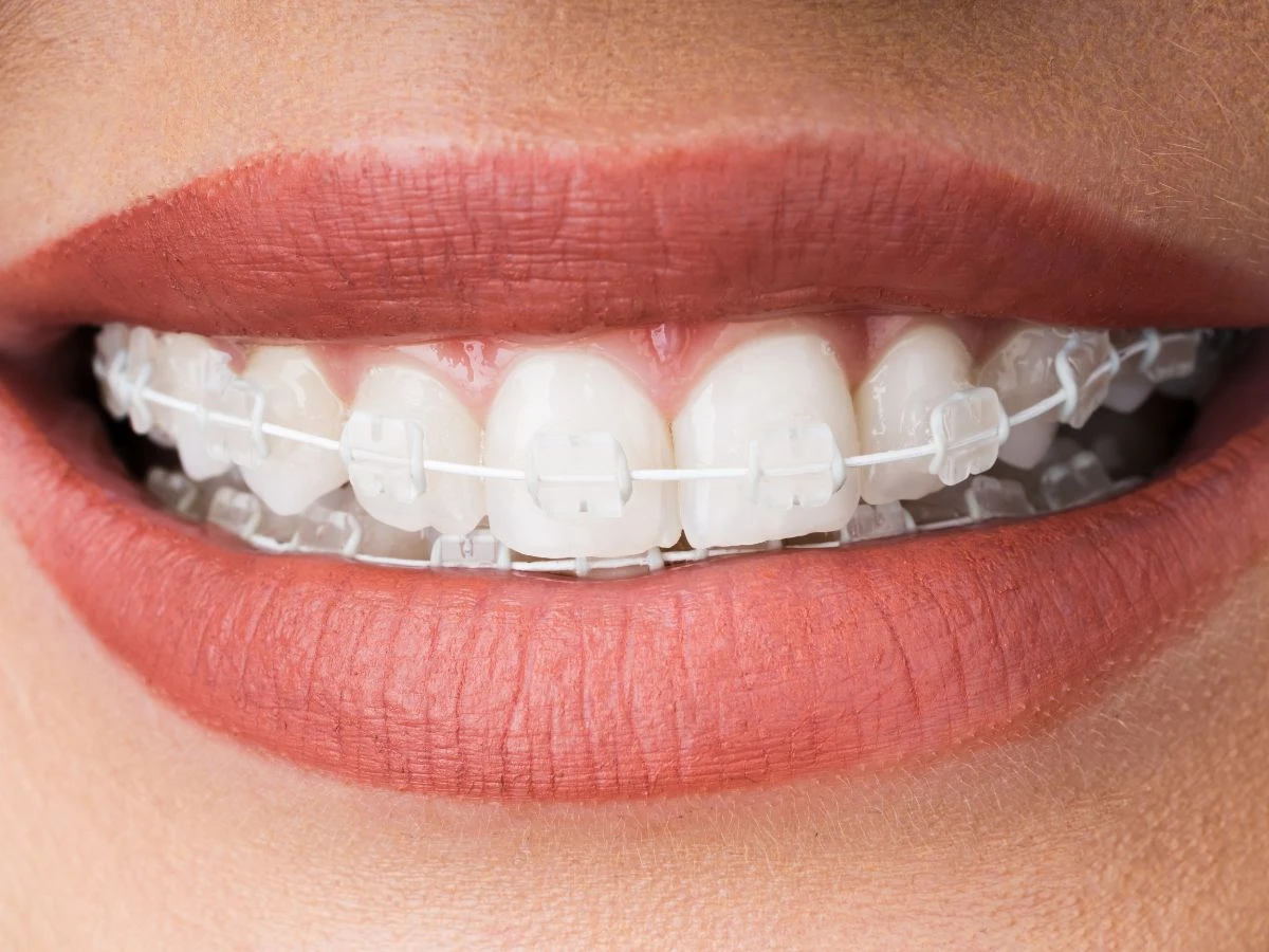 Sonrisa brackets estéticos