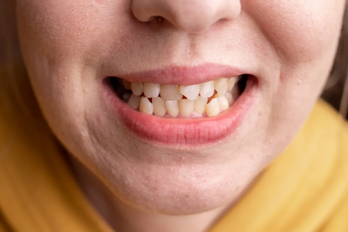 Inestabilidad oclusal