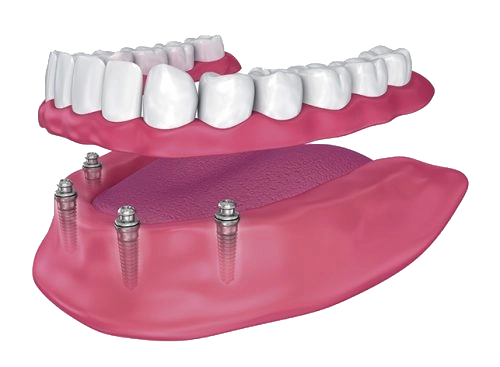 Prótesis sobre implantes