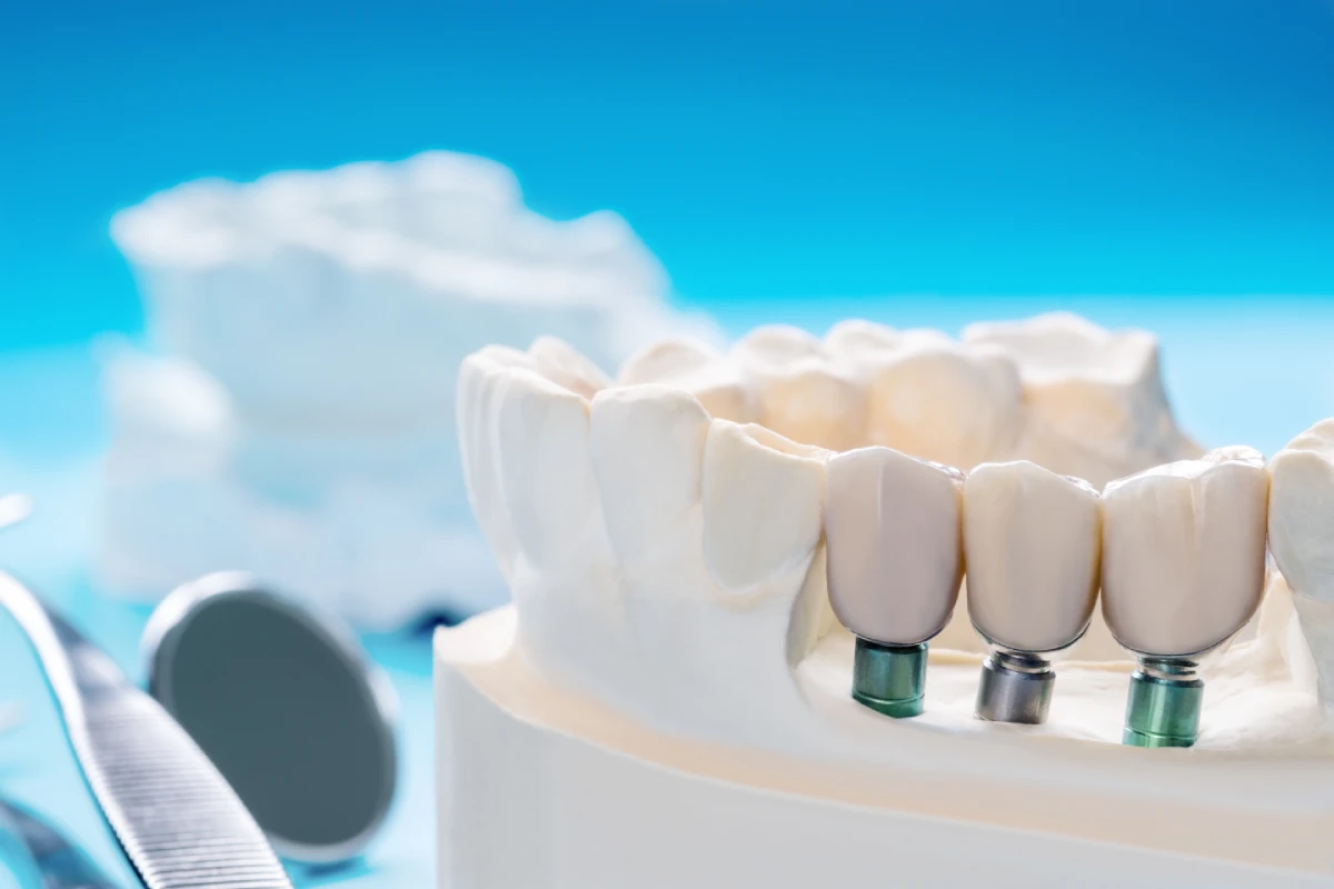Puente sobre implantes